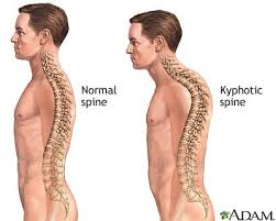 Upper Crossed Syndrome A Chiropractor S Guide To Postural Pain