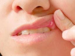 Image result for Canker sores roof of mouth