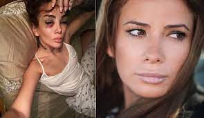 Айза анохина родилась в городе грозном, в ещё совсем юном возрасте она переехала с родителями жить в москву. Plastika Ajzy Anohinoj Ajza Do Plastiki I Posle Lifestyle