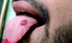 Image result for cancer tongue symptoms)