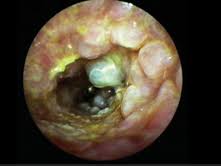 Exam Ii Ceruminous Gland Pathology Of The External Ear Canal Flashcards Quizlet