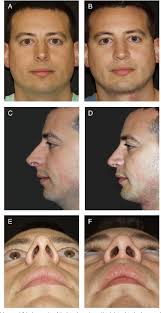 Figure 7 from Mattress sutures to remove unwanted convexity and concavity  of the nasal tip: 12-year follow-up.