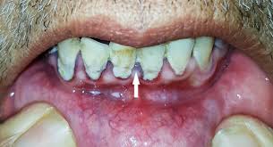 Image result for Lead Poisoning