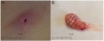 Here are 18 simple, proven tips if left untreated, ingrown hair can cause an infection in the area of the skin where it occurs, create unsightly bumps. Florida Woman Discovers Deeply Embedded Maggot In Her Groin Health Com