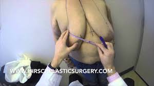 Your price could range from $25 to $16,000, depending on the specifics of your surgery and whether your insurance covers a significant portion of the cost. Los Angeles Breast Reduction