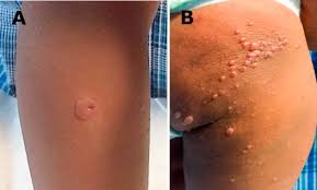Check spelling or type a new query. Vesiculobullous Eruption As An Atypical Hand Foot And Mouth Presentation The Journal Of Pediatrics