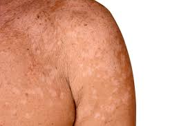 Image result for Skin Infection