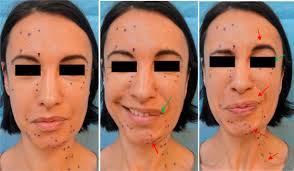 Some of the toxins (b and e) also precipitate nausea, vomiting, and difficulty with talking. Sequelles De Paralysie Faciale Et Toxine Botulique Sciencedirect