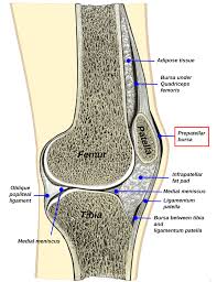 Image result for Prepatellar Bursitis