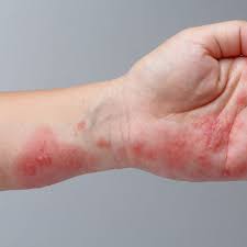 Image result for skin rash similar to scabies