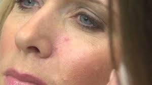 If you've received a diagnosis, here are some things you need to know about the condition. Sarah Discovers Assumed Blemish Is Cancer