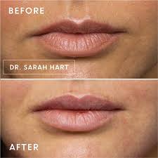 Jul 19, 2021 · botox lip flip before and after images july 19, 2021 masuzi lip flip or filler which is right for you capizzi md lip flip vs filler which is right for me boss gal beauty bar botox lip flip everything you need to know find a better relaxing your upper lip with a botox flip siti med spa Gallery Before And After Photos By Dr Sarah Hart
