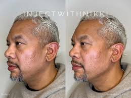 Looking for glowwy & hydrated skin that lasts 6 months? 💧 Get $75 off your  first treatment of SKINVIVE™ by JUVÉDERM® until 10/18/2024 at Phase Plastic  Surgery SKINVIVE™ by JUVÉDERM® helps the