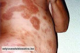 Quando si tratta di una situazione preoccupante? Come Identificare E Curare La Sclerodermia Auto Malattie Autoimmuni It Odysseedubienetre Be