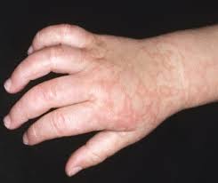 Röteln und ringelröteln sind ansteckende kinderkrankheiten, die von unterschiedlichen viren verursacht werden. Dermatologie Ringelroteln Und Dreitagefieber Pta Forum