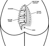 The Cleft Lift Procedure Evergreen Surgical Pilonidal Clinic In 2021 Pilonidal Cyst Cysts Colorectal