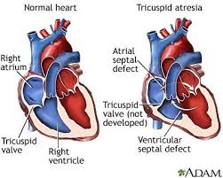 Tricuspid Valve Atresia When The Tricuspid Valve Is Underdeveloped And Sealed Instead Of Divided With Three Pediatric Nursing Nursing Exam Clinical Nurse