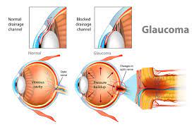 Goggles4u.com has been visited by 10k+ users in the past month The Facts About Glaucoma Harvard Health