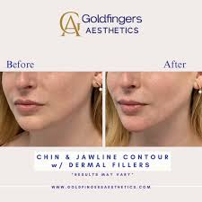 NEW 👇 💋Half JUVEDERM Ultra XC Lip Filler Syringe only $319!! Offer valid  while supplies last valid at all Goldfingers Aesthetics Locations 🔗 in Bio  Call (407) 333.4300 or Text After Hours (