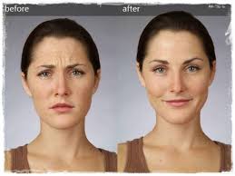 The Pros And Cons Of Botox Botox Botox Injections Natural Botox