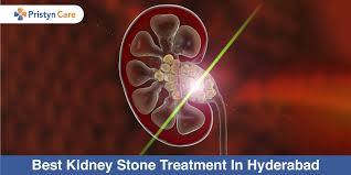 Kidney Stones Archives Pristyn Care