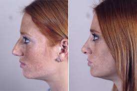Definitive guide to nose bump, including causes, symptoms and available treatments. What Can Nose Surgery Fix