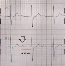 Maybe you would like to learn more about one of these? First Degree Atrioventricular Block Wikipedia