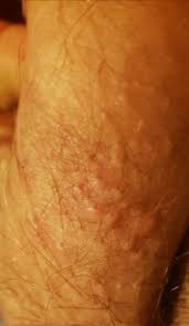 Ingrown hair and genital warts are similar in the sense that they mostly affect the same parts of your body. Is This Herpies Genital Warts Or Ingrown Hair Sexual Health Forums Patient