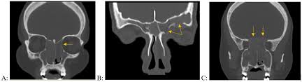 Cureus Paranasal Sinus Wall Erosion And Expansion In Allergic Fungal Rhinosinusitis An Image Scoring System