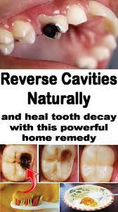 Reverse Tooth Decay Naturally At Your Home Wellness Tips For You Teethhealth Toothcavity Tooth Decay Remedies Natural Healing Remedies