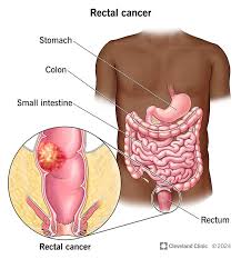 Image result for Constipation in Cancer