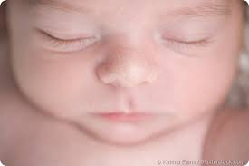 Milia In Babies