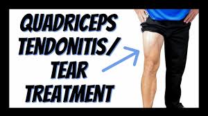 Strains are seen in all the quadriceps muscles but are most common in rectus femoris, which is more vulnerable to strain. Quadriceps Tendonitis Or Tear Single Best Treatment You Can Do Yourself Updated Youtube