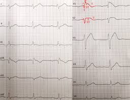 Av noduyla reentry hastaların %60'ında, %20'sindeyse baypass kullanımını içeren reentry vardır. Management Of Tachycardia Amboss