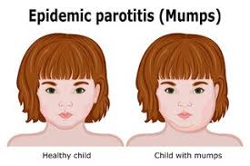 Image result for Mumps
