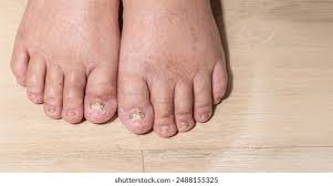 Image result for Koilonychia feet