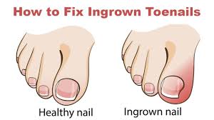 Check spelling or type a new query. How To Fix Ingrown Toenails At Home Youtube