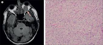 Tried, tested, trusted and affordable for all qpcr needs. Orbital Metastases From Malignant Mesothelioma The Lancet Oncology