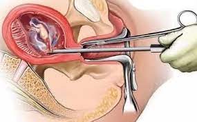 Un legrado es una operación quirúrgica que consiste en raspar la superficie del útero y extraer parte del endometrio (la capa mucosa que recubre. Legrado Enemigo De Un Futuro Embarazo Eres Mama