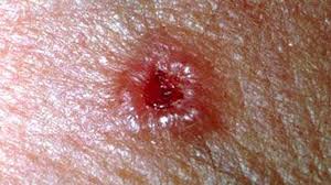 According to the american cancer society, just over 100,000 new cases of skin cancer are diagnosed in the united states each year. Skin Cancer Symptoms Pictures Types And More