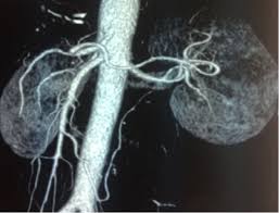 Nutcracker Syndrome A Case Report