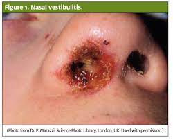 As this is a bacterial infection, treatment is done using antibiotics, such as dicloxacillin. Painful Nose Crusting In A Child Journal Of Urgent Care Medicine