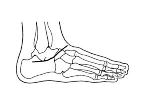 Many cincinnati abdominoplasty patients include women seeking help after multiple pregnancies. Watkin S Manual Of Foot And Ankle Surgery Plastic Surgery Flashcards Quizlet