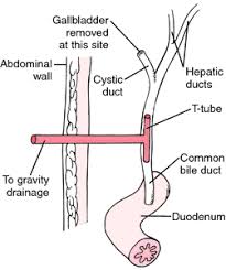 Cholecystectomy Gallbladder Surgery Medical Dictionary Gallbladder