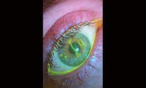 First Aid For Eye Scratches