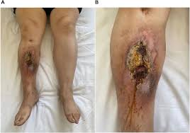 Image result for Osteomyelitis