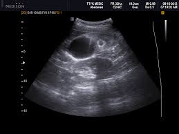 Vietnamese Medic Ultrasound Case 144 Abnormal Gall Bladder Dr Phan Thanh Háº£i Medic Medical Center Hcmc Vietnam
