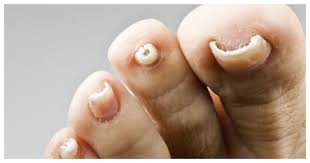 Hongos En Las Unas De Los Pies Los 5 Mejores Remedios Caseros Enfermedades The Epoch Times En Espanol