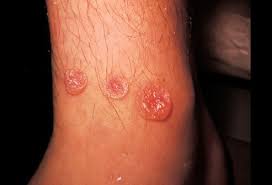 Typically, a brown recluse bite is considered medically significant, because the bite can quickly become necrotic if not treated properly. Brown Recluse Spider Bites Picture Image On Medicinenet Com