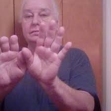 Fundraiser by Judy Walker : Help Ronny Replace His Fingers